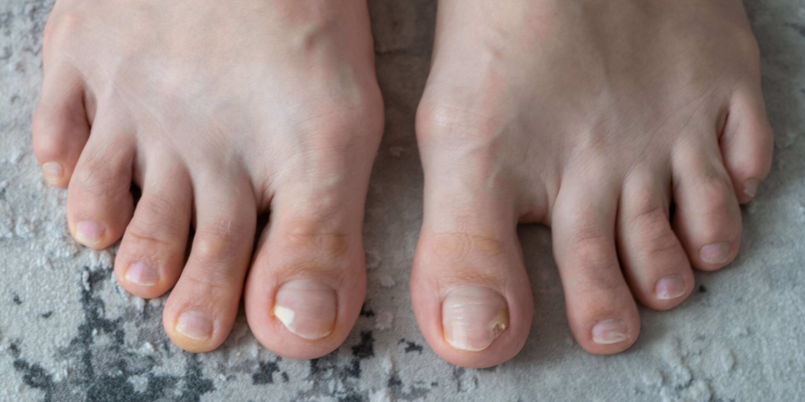 person feet close up, fungus, broken nail, skin infection, toe mycosis, treatment needed, fungal infection concept, onychomycosis, onycholysis, nail separates from nail bed