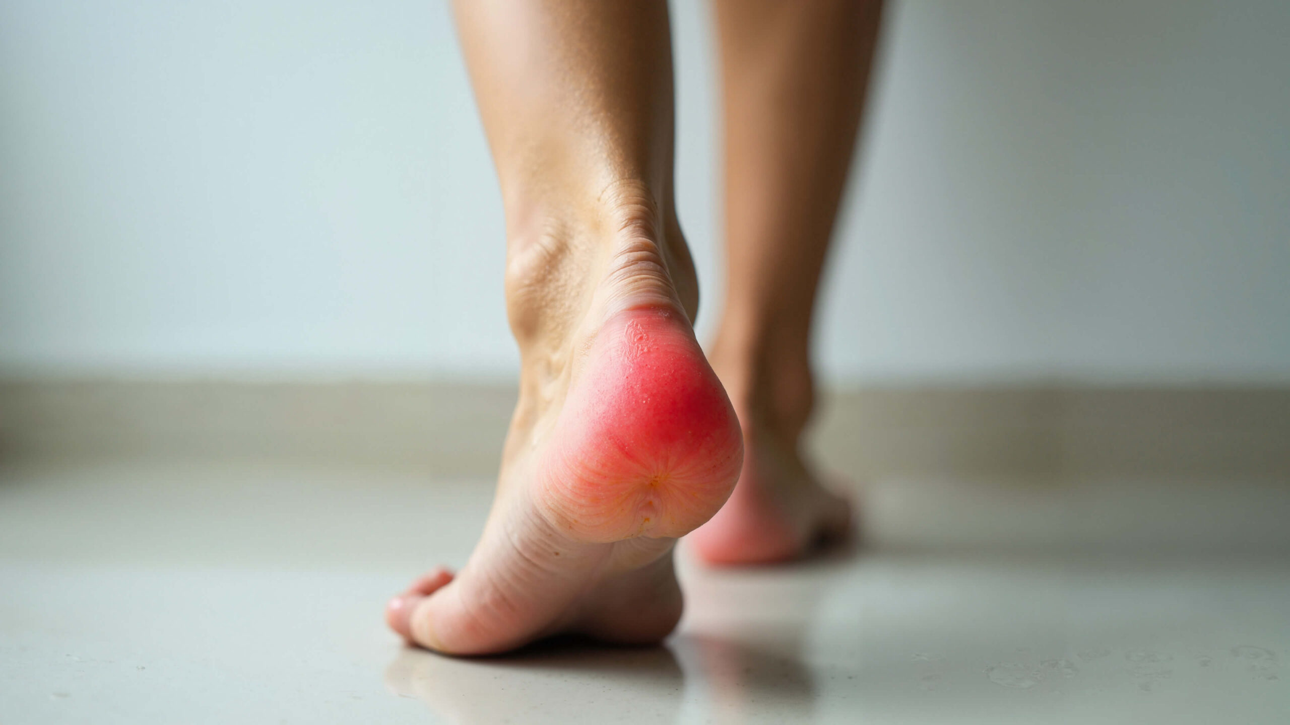 Close-up of a female foot with inflamed heel, ideal for healthcare education, wellness blogs, and foot health campaigns.