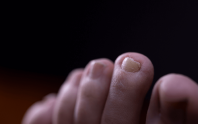 Top 5 Warning Signs of Fungal Toenails