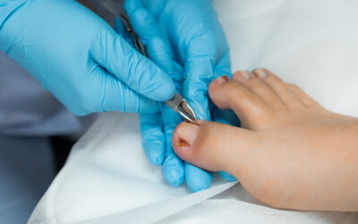 How To Fix Ingrown Toenails Permanently