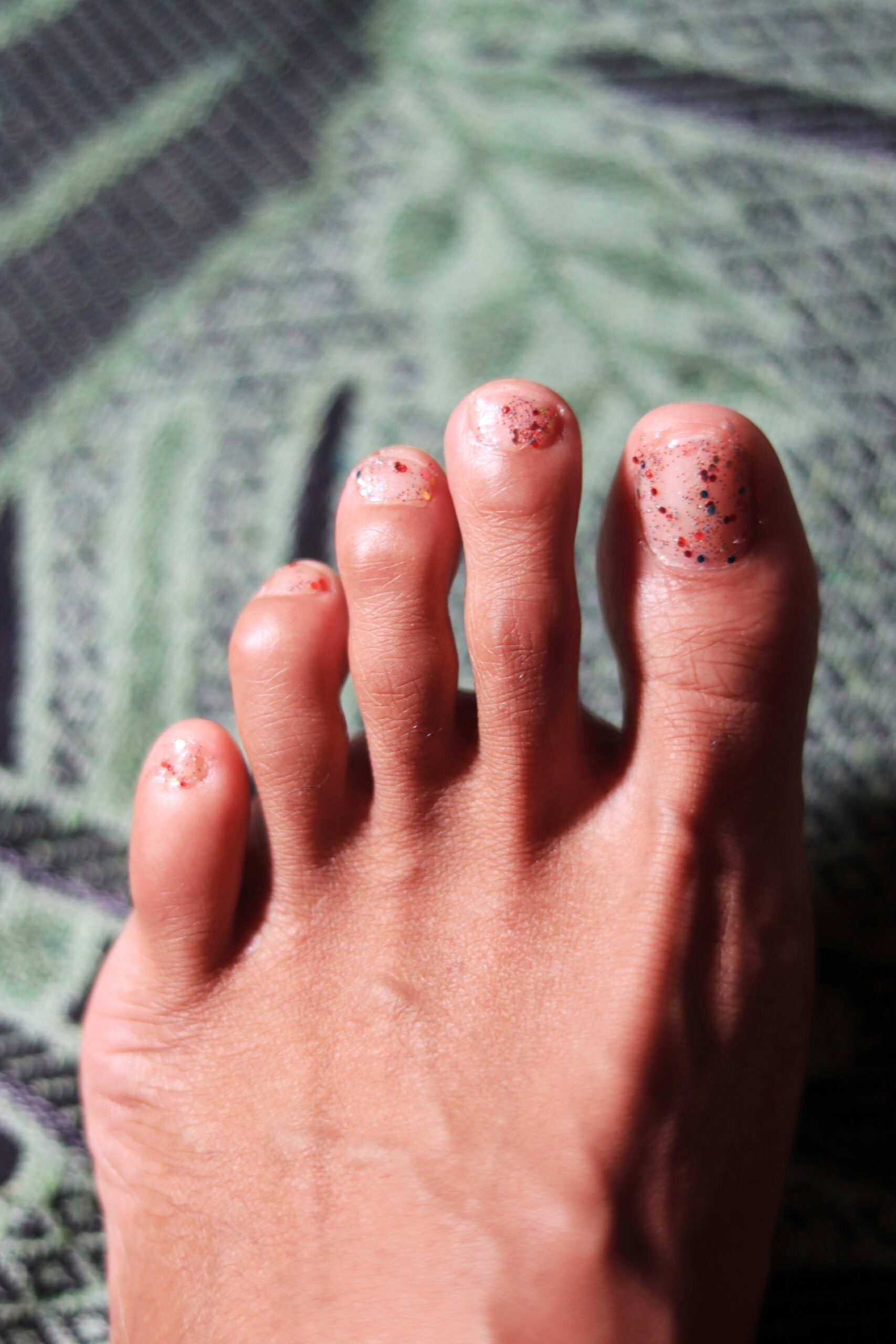 Picture of foot with Hammertoe