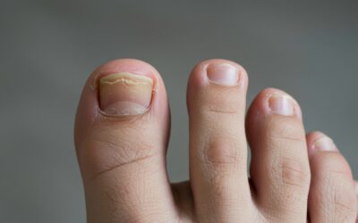 How to Get Rid of Yellow Toenails Quickly