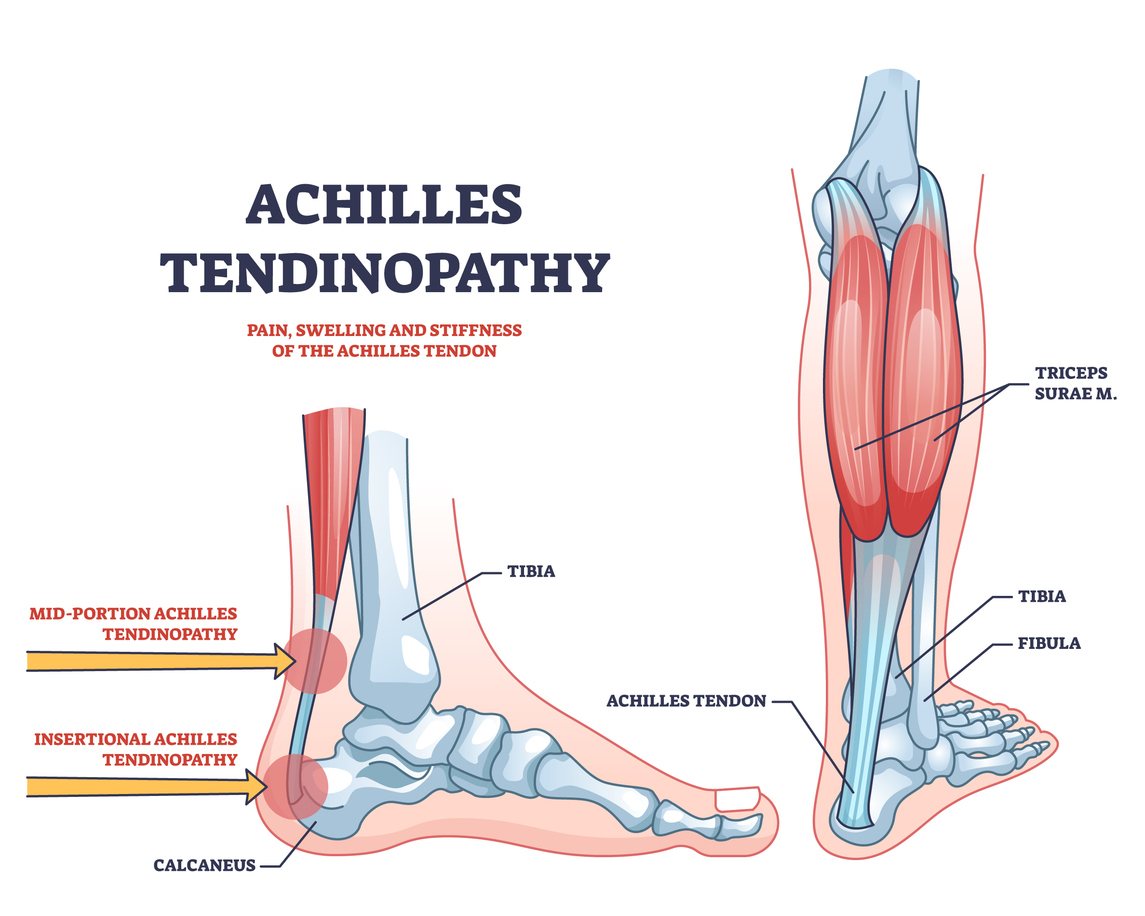 Achilles tendonitis