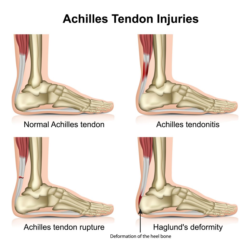 Treating Achilles tendonitis