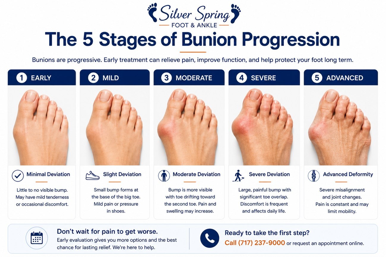 The stages of bunion progression