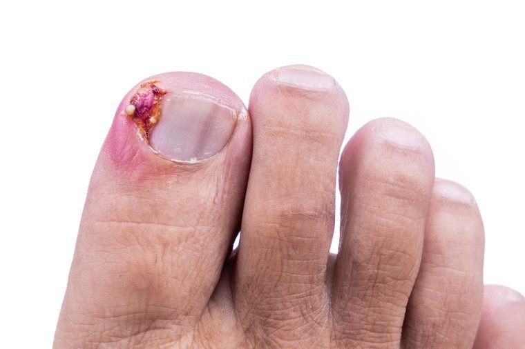 Ingrown Toenails