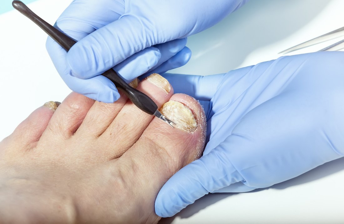 Nail debridement treatment