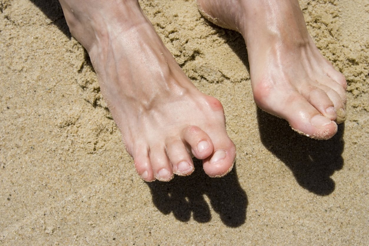 Hammertoe with a bent middle joint