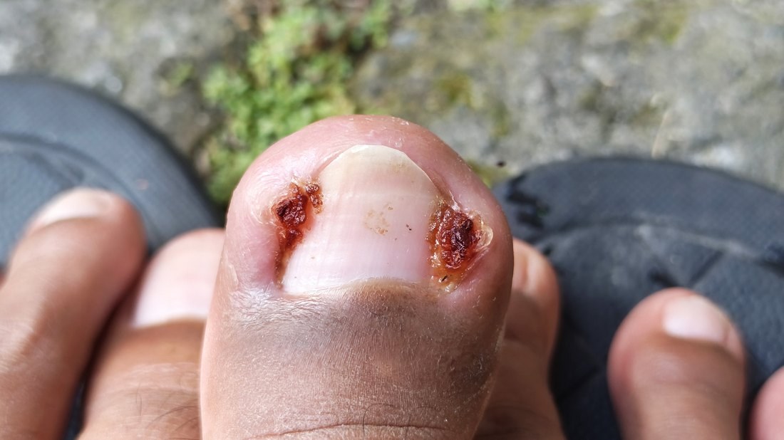 Ingrown toenail