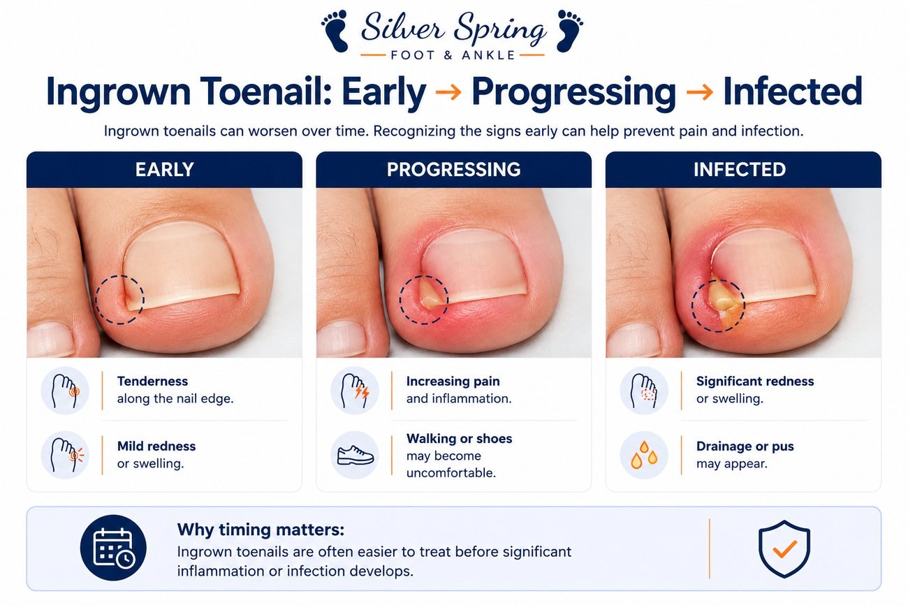 Ingrown toenail progression