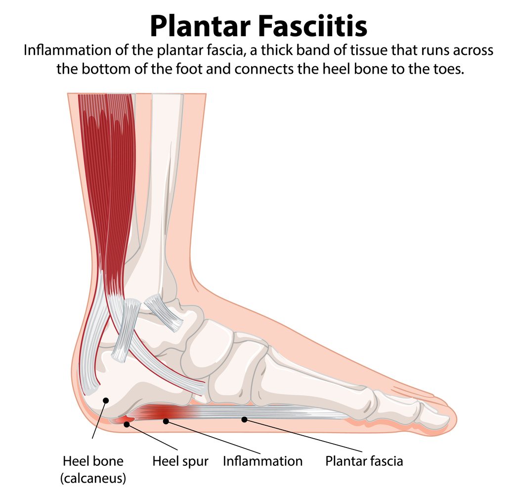 Plantar fasciitis heel pain