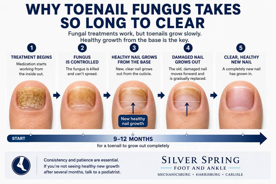 Illustration: Why Toenail Fungus Takes So Long to Clear; toenails grow slowly
