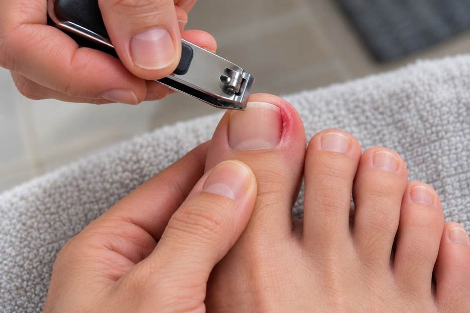 Man with a toenail clipper and ingrown toenail; how to cut an ingrown toenail