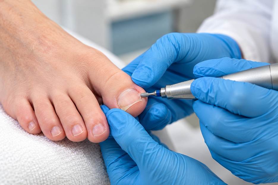 Podiatrist removing an ingrown toenail