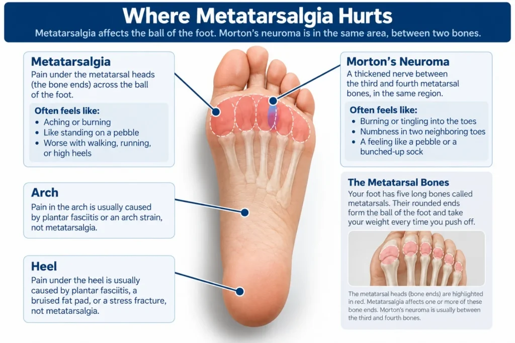 Illustration: Where metatarsalgia hurts compared with Morton’s neuroma, arch pain, and heel pain